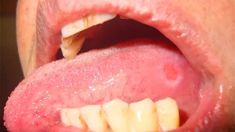 Opos burnoje: foto, priežastys ir gydymas