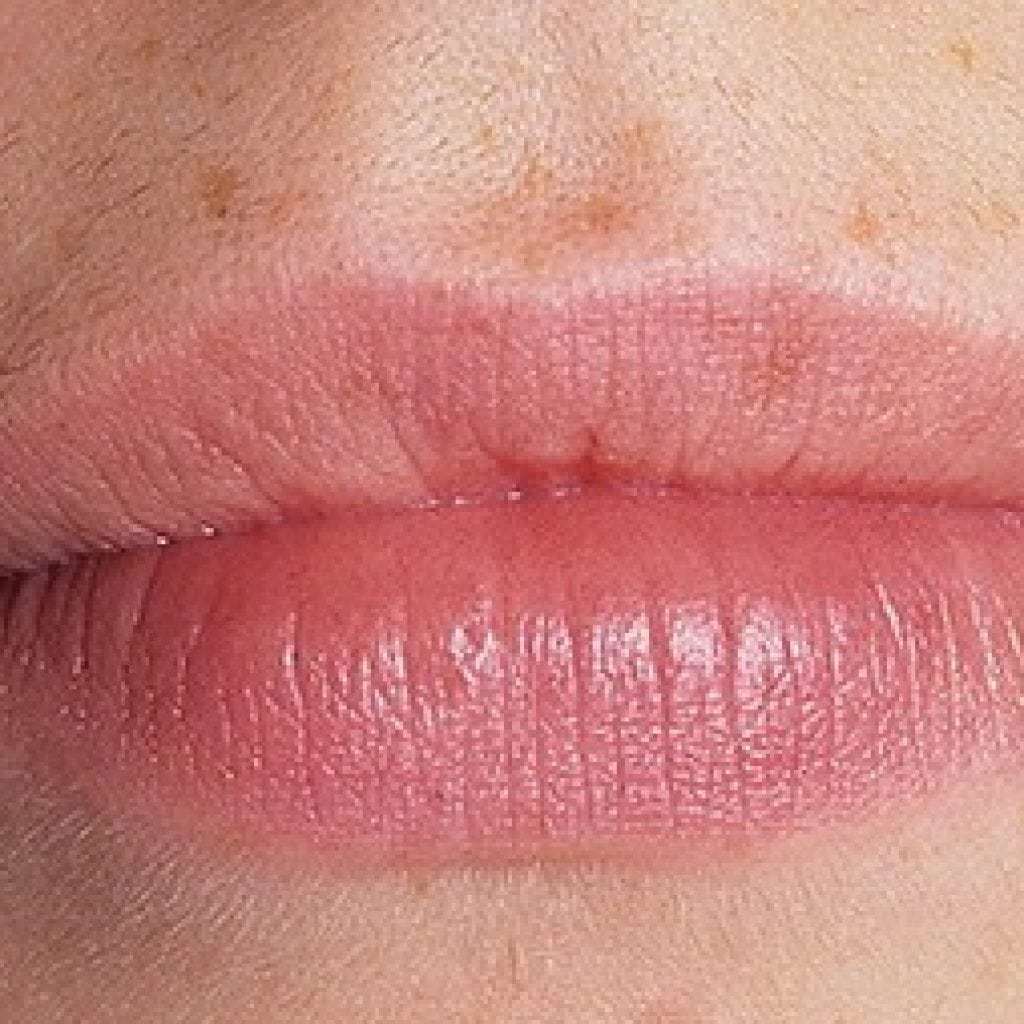Kako brzo liječiti napadaje u kutovima usta kod odraslih i djece