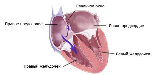 Patent foramen ovale i hjertet forårsager, symptomer, behandling og prognose
