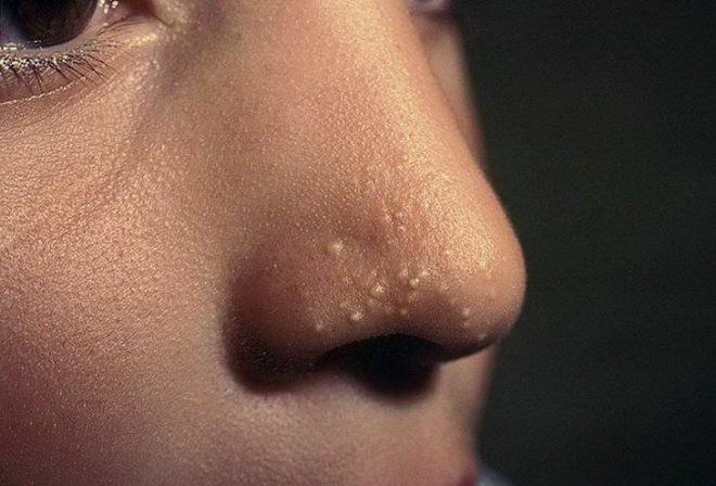Hoe zich te ontdoen van de Grauwe Gors op het gezicht: behandeling miliums