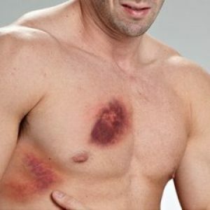 Contusion-chest-cells