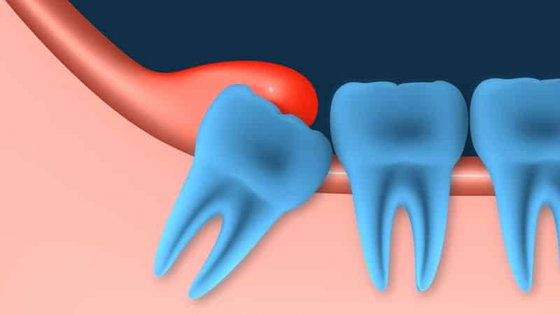 Warum entzündetes Zahnfleisch und wie sie behandeln
