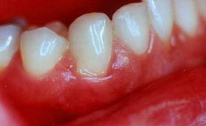 Dental Kleberpaste Solkoseril: eine einzigartige Zusammensetzung und Anwendung in der Zahnarztpraxis, der Preis des Arzneimittels