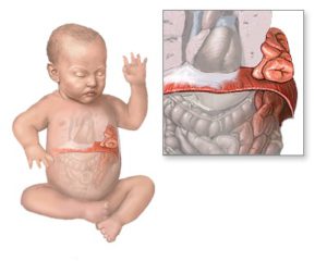 Hernia del esófago en un niño.