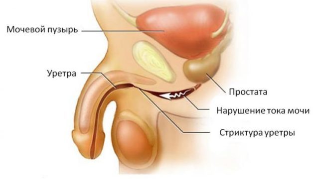 Mittespetsiifiline uretriit, kuidas diagnoosida ja ravida meestel