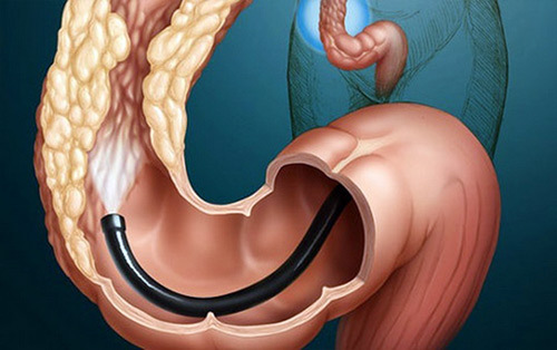 Diagnosis of diverticular disease of the colon