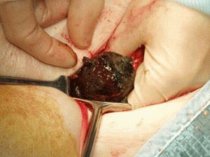 Remoção de cálculos intestinais cirurgicamente