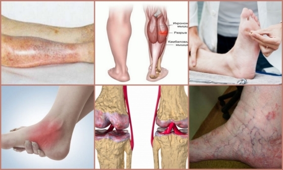 Ostéochondrose des jambes: causes, symptômes, traitement