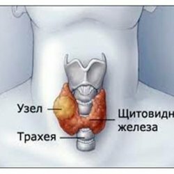 Doenças da glândula tireoidea