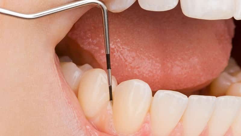 Inflammation i tandköttet runt tanden: behandlingsmetoder, foton