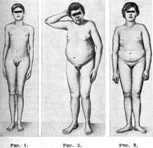 Hypogonadism in men