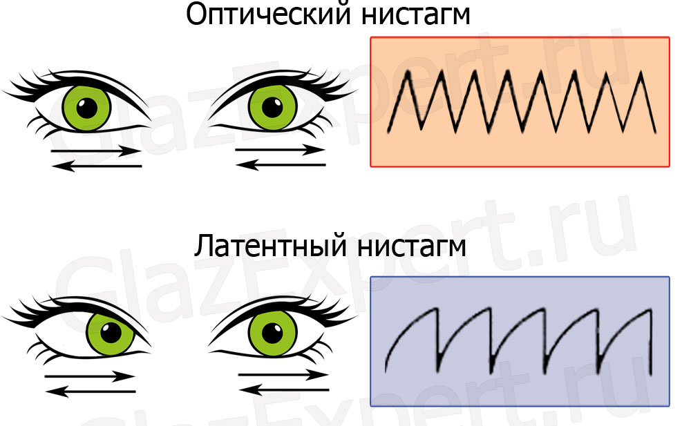 Nystagmus: co to je, příčiny, příznaky, léčba, prognóza