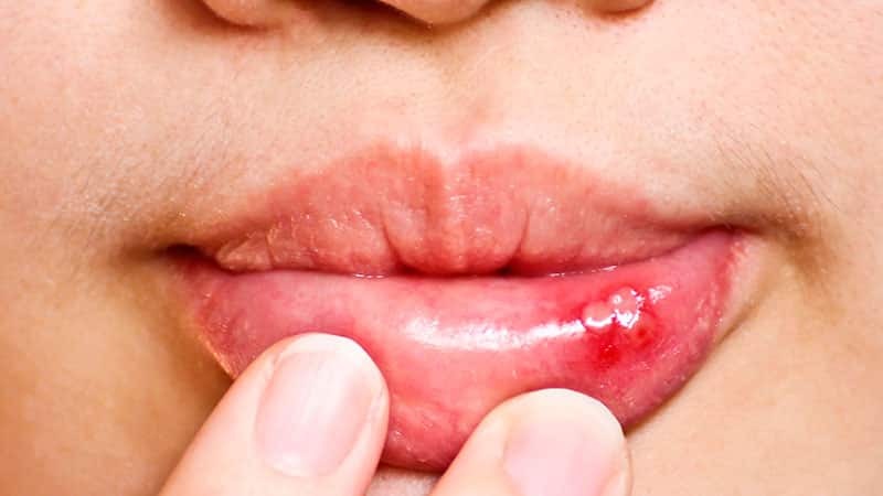 Sores in the mouth: causes and treatment, photo