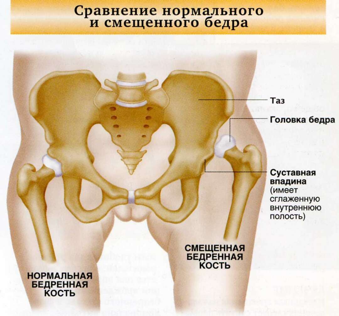 Dislocation of the hip