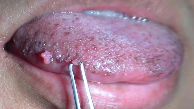 Papilloma in the mouth photo