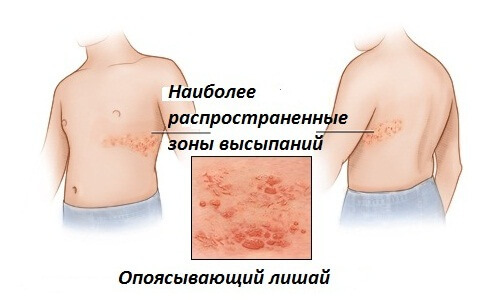 Herpes zoster: symptoms and treatment
