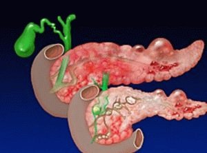 Pancreasziekte