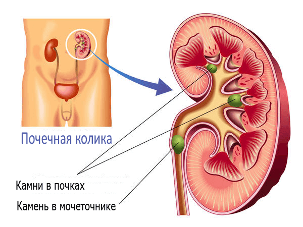 Renal colic - causes of development, symptoms and treatment principles