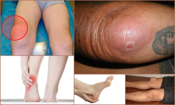 Heel bursitis: tünetek, kezelés, fotók
