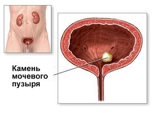 Steen-in-urine blaas