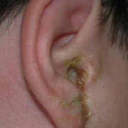 Infeksi telinga sepsis