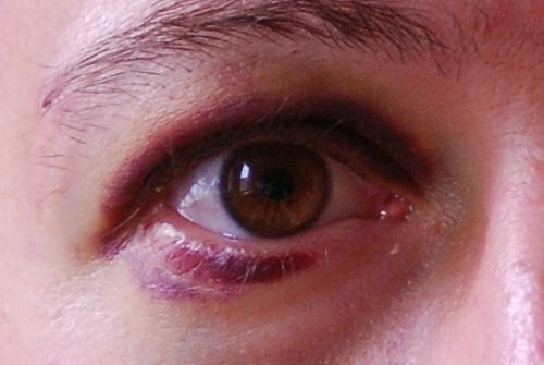 poranenia očí: príznaky a liečba