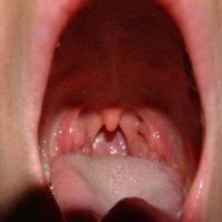 Entzündung der Tonsillen: Behandlung