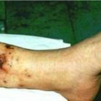 Trophic ulcers of lower leg
