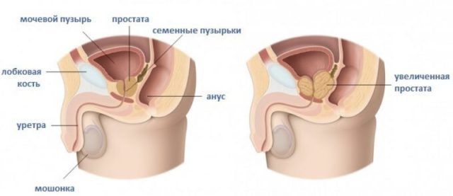 Drug treatment of prostate adenoma
