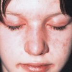 Dermatomyositis: wat is het, symptomen en behandeling, foto