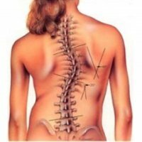 Vrodená skolióza chrbtice