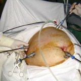 Laparoscopic surgery to remove the gallbladder