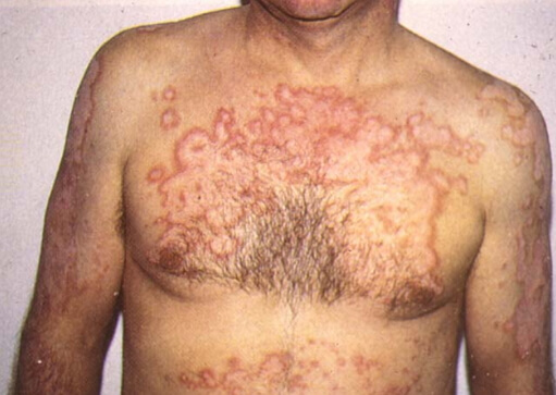 Tuberkuloza fotografije kože tijela