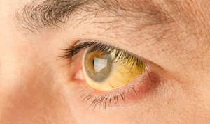 Vergilbung von Augenproteinen bei Hepatitis