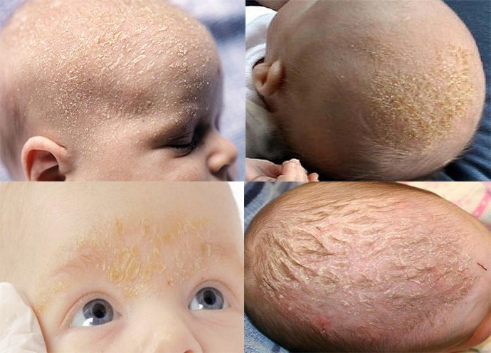 Seborrhoische Dermatitis bei Kindern: Fotos, Behandlung, Komarovskys Rat