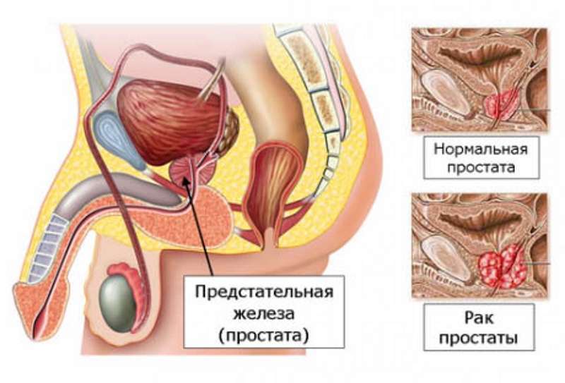 Stadij raka prostate i prognoze