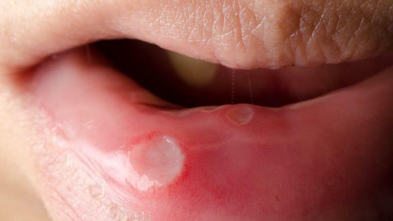 Causes stomatitis in adults