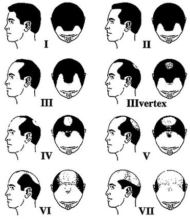 Stadier af androgen alopeci