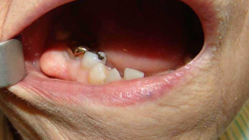 cista v zdravljenju ustih otroka