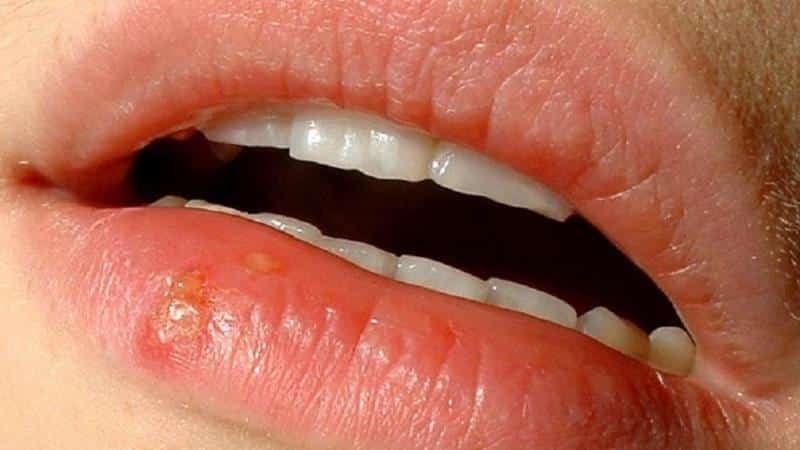 stomatitis usne slika
