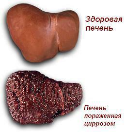 La cirrosis del hígado en la foto