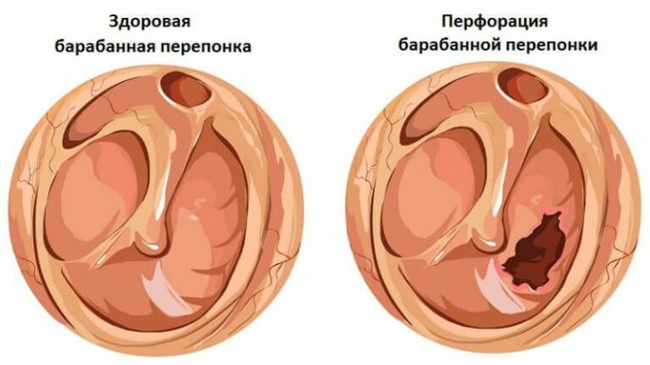 Burst of the eardrum: symptoms, treatment and consequences