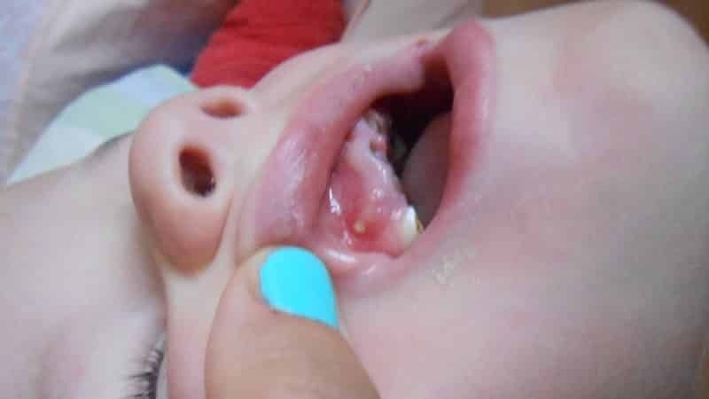 Hvid plet på tandkødet i den voksne og barnet