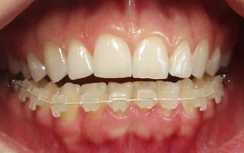 Foto Zahnspange auf die Zähne