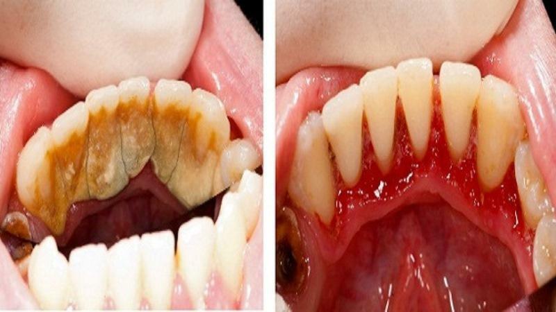 Oral infections treatment