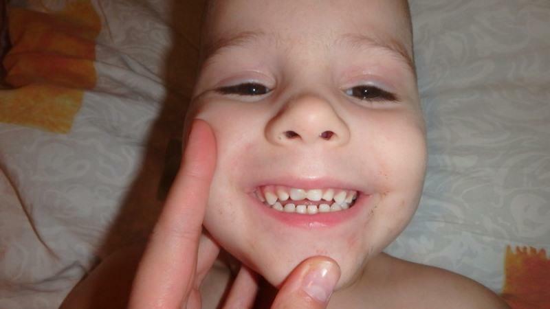 ein Baby Zahn des Kindes abgedunkelten