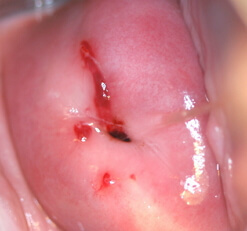 Foto van de oorzaken van cervicale erosie