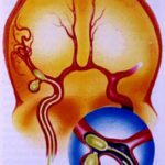 Aneurysm of the brain
