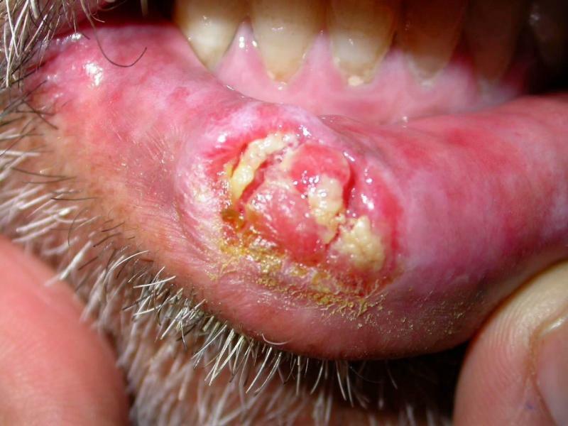 Rak na usnama prvih znakova simptoma