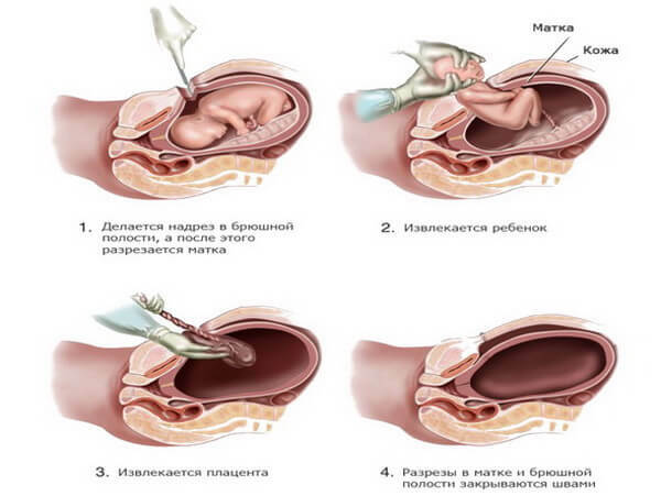 Oligohydramnion tijdens de zwangerschap: oorzaken, gevolgen en behandeling van